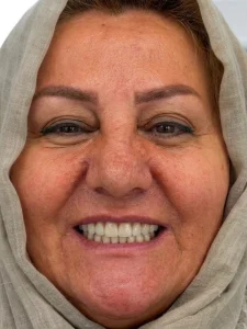 اوردنچر بعد