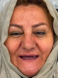 اوردنچر قبل